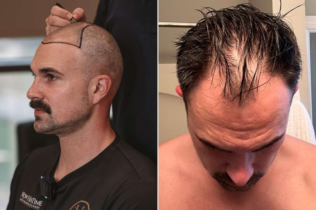 Hair Transplant UK: FUE, FUT, and SMP Options Available